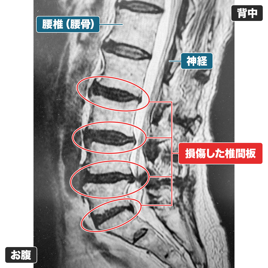 MRI