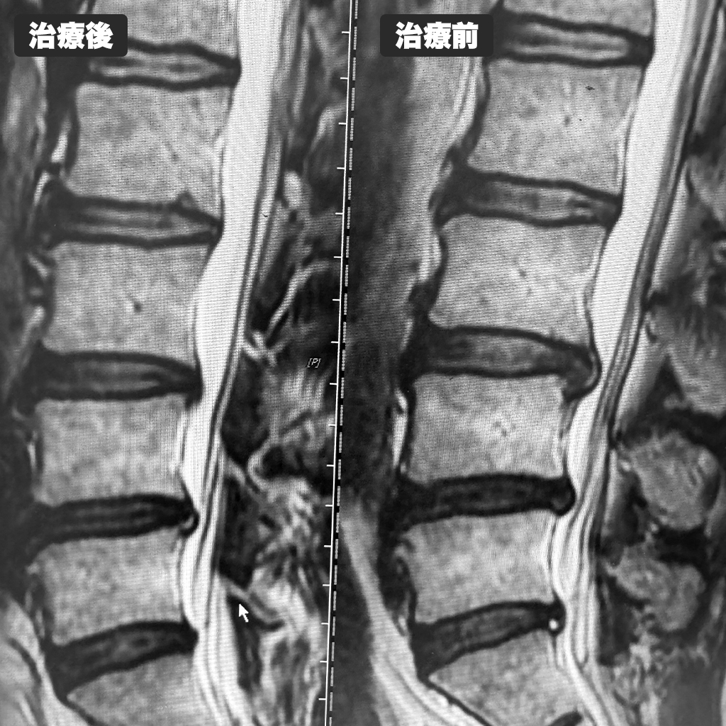 治療前後のMRI写真