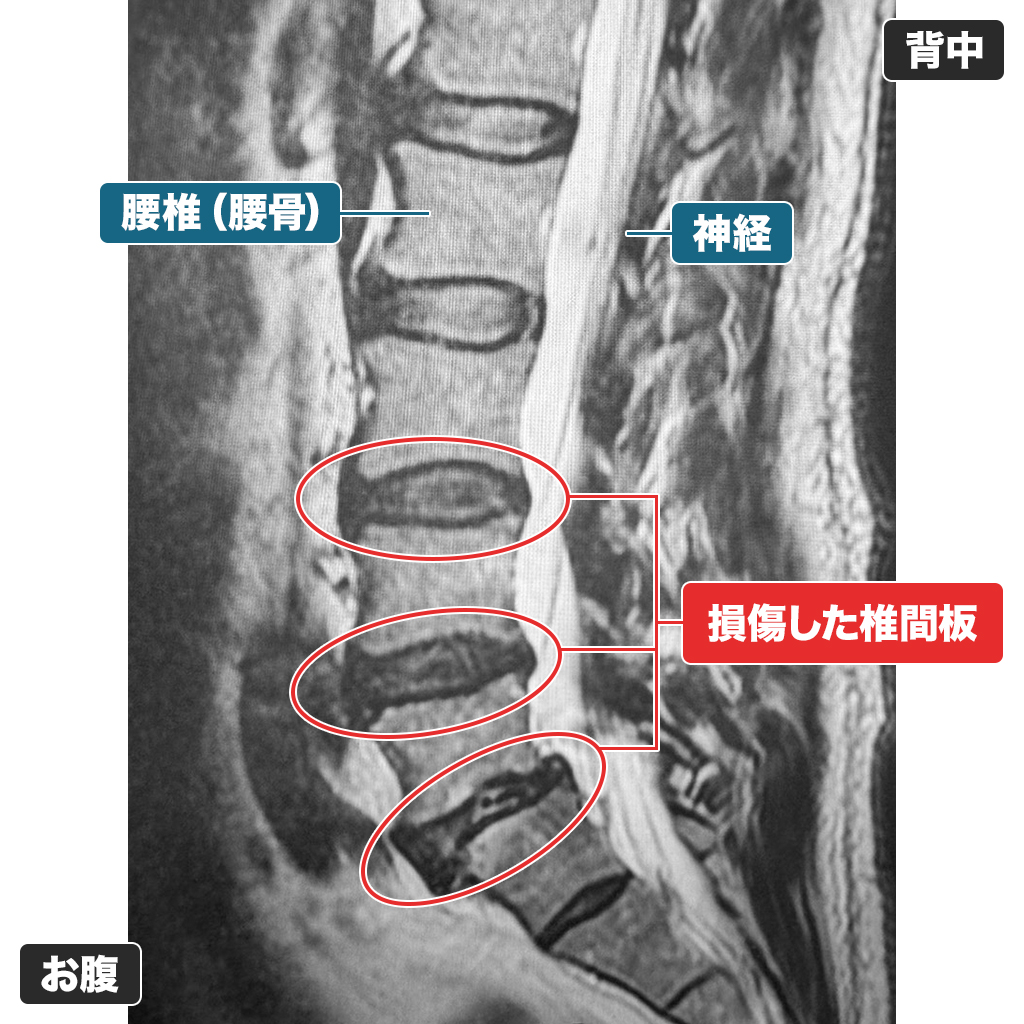 MRI