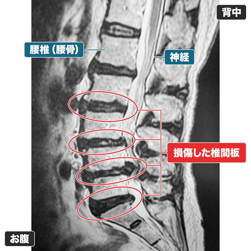 MRI