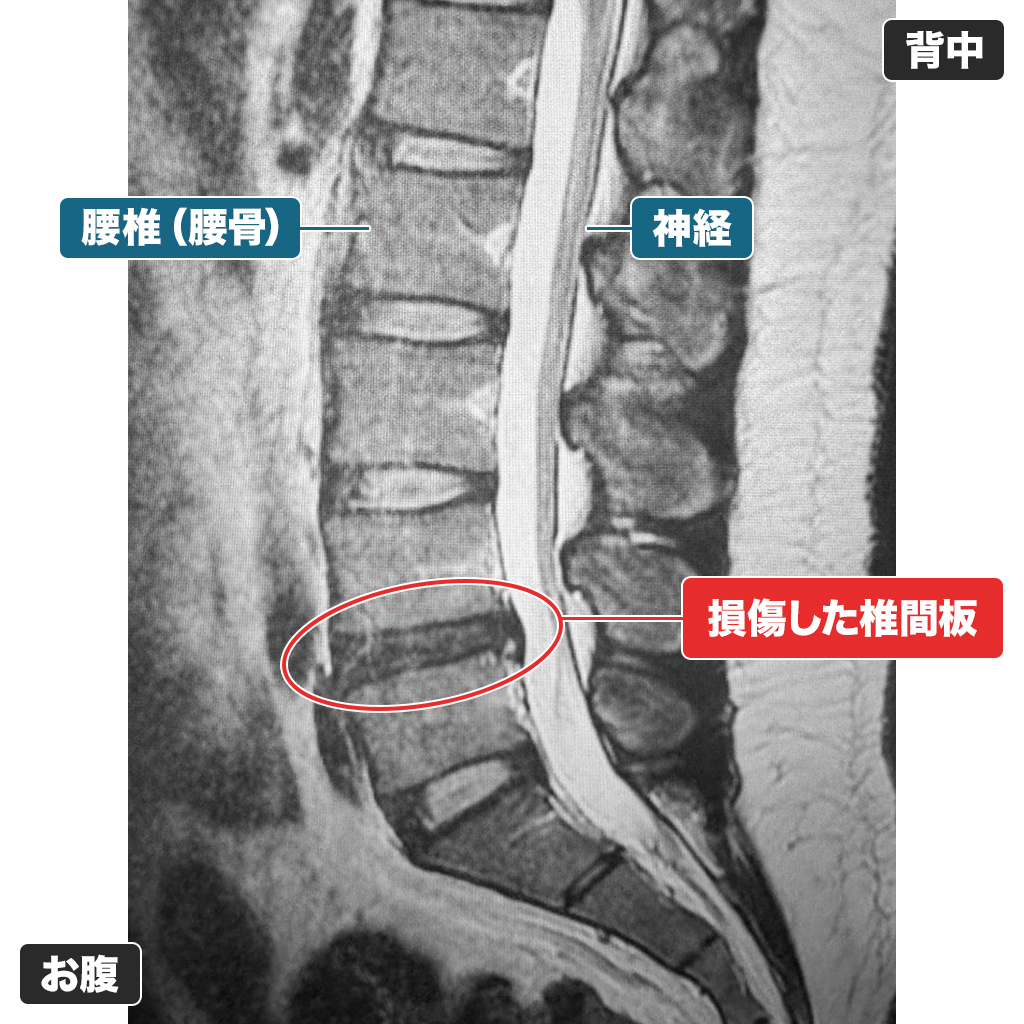 MRI