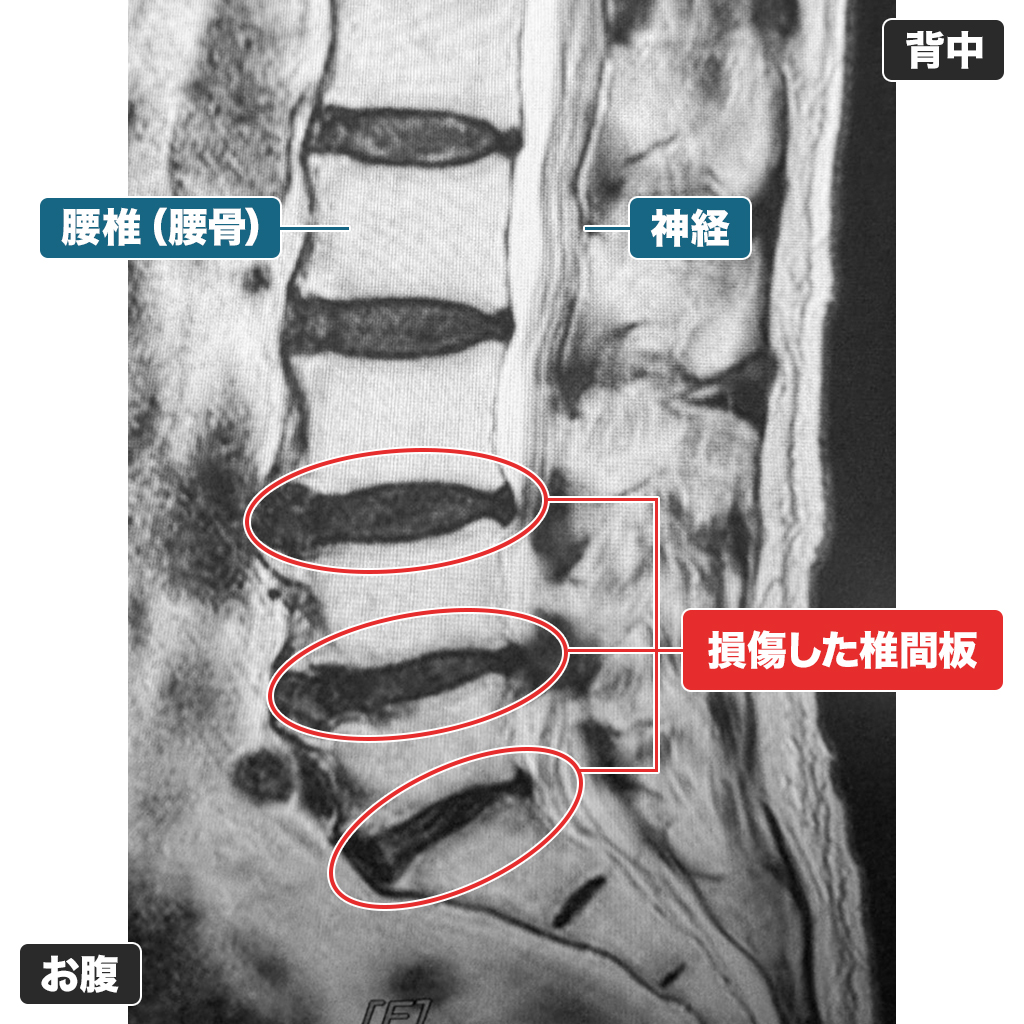 MRI