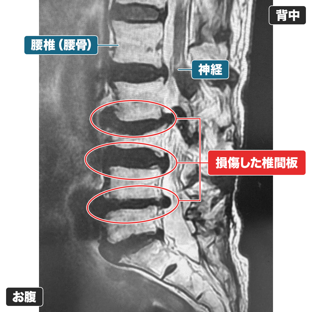 MRI