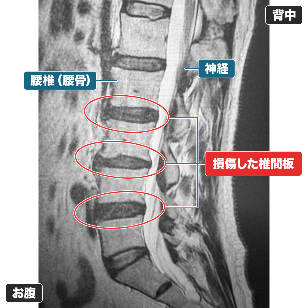 MRI