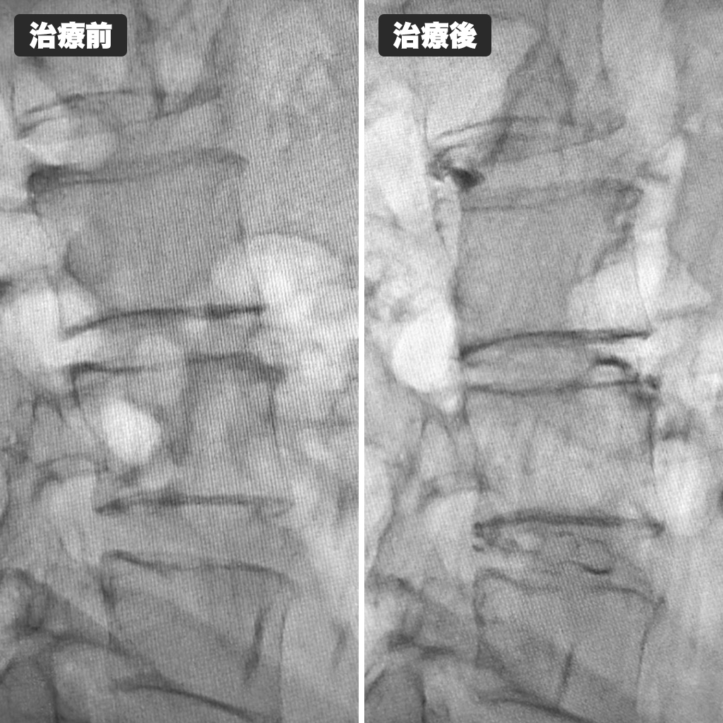 治療前後のレントゲン写真