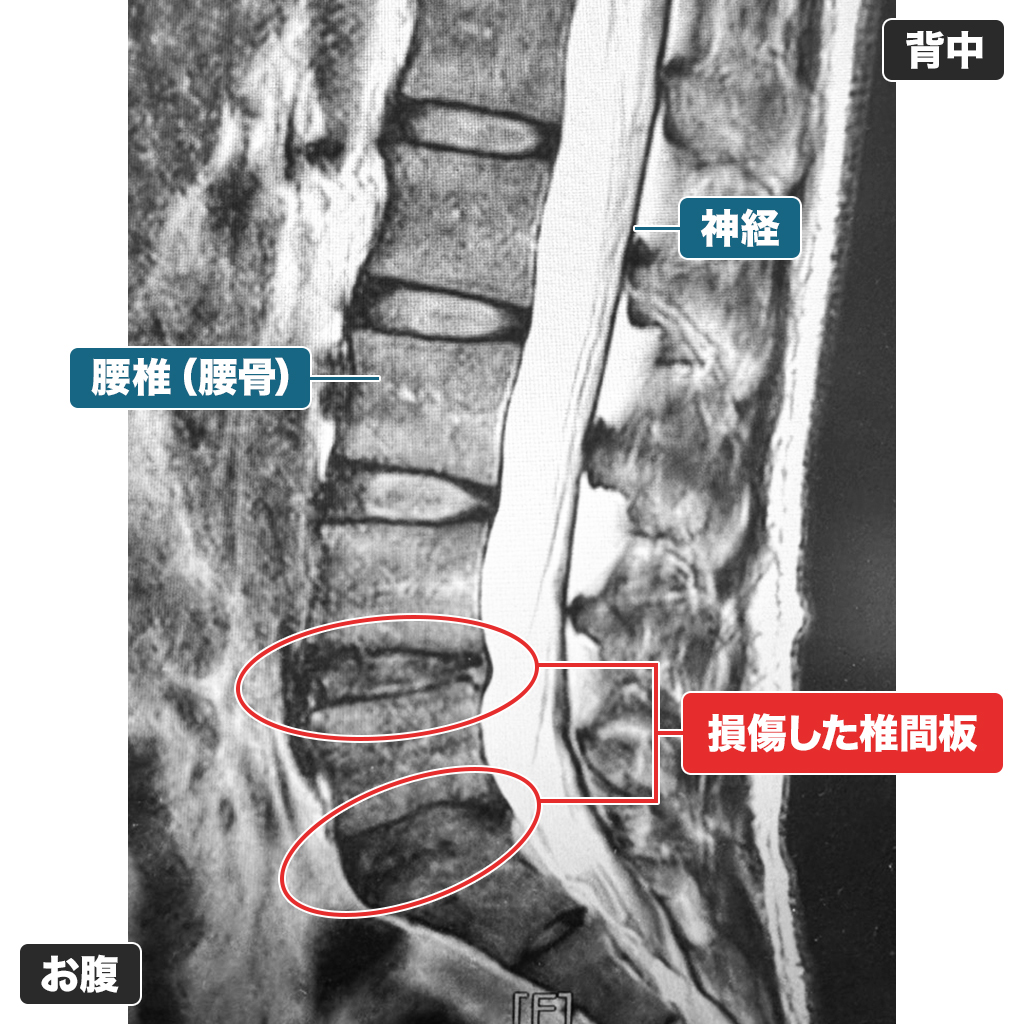 MRI