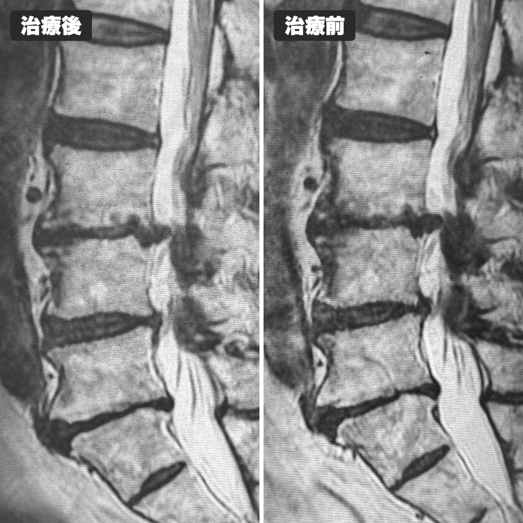 治療前後のMRI写真