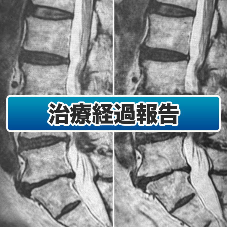 ディスクシール治療後1年4ヶ月経過した50代男性