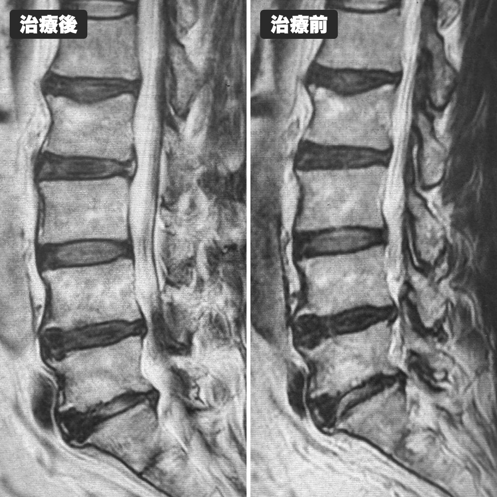 治療前後のMRI写真