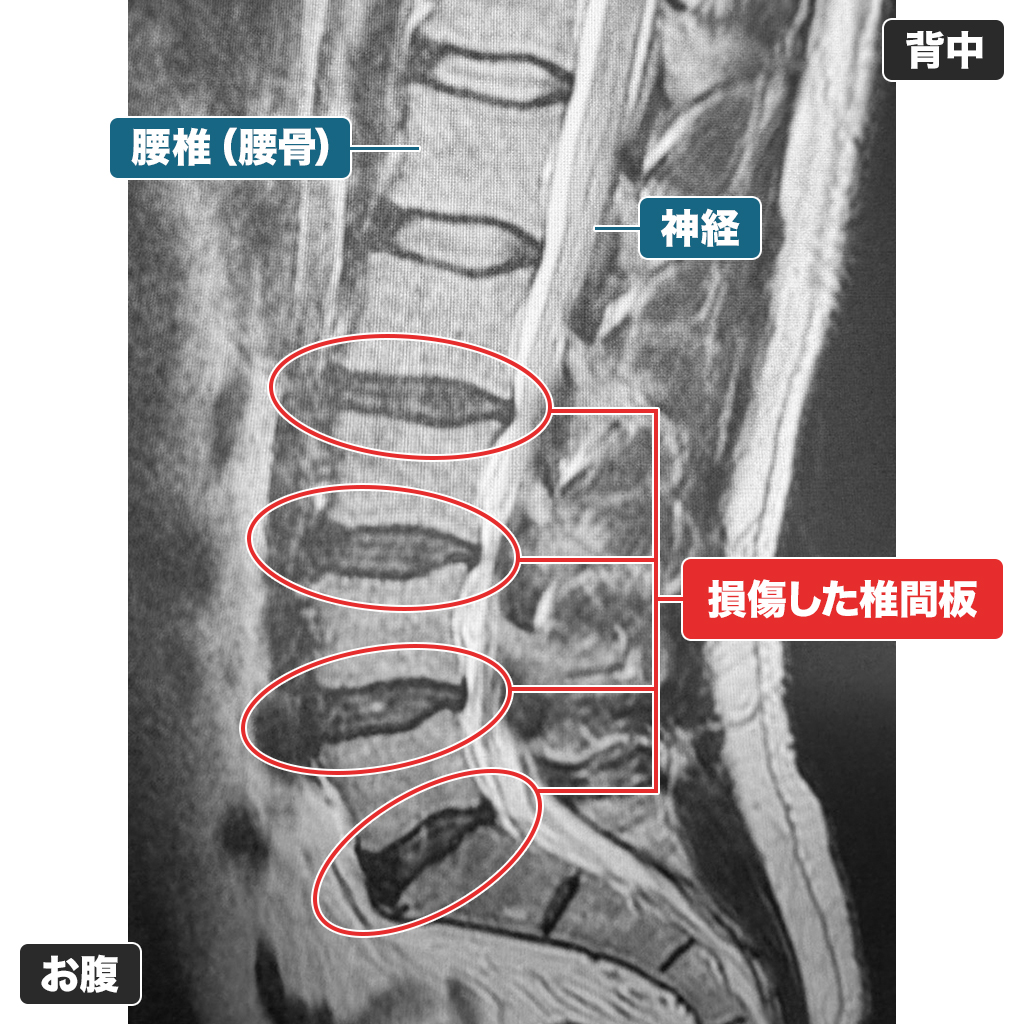 MRI