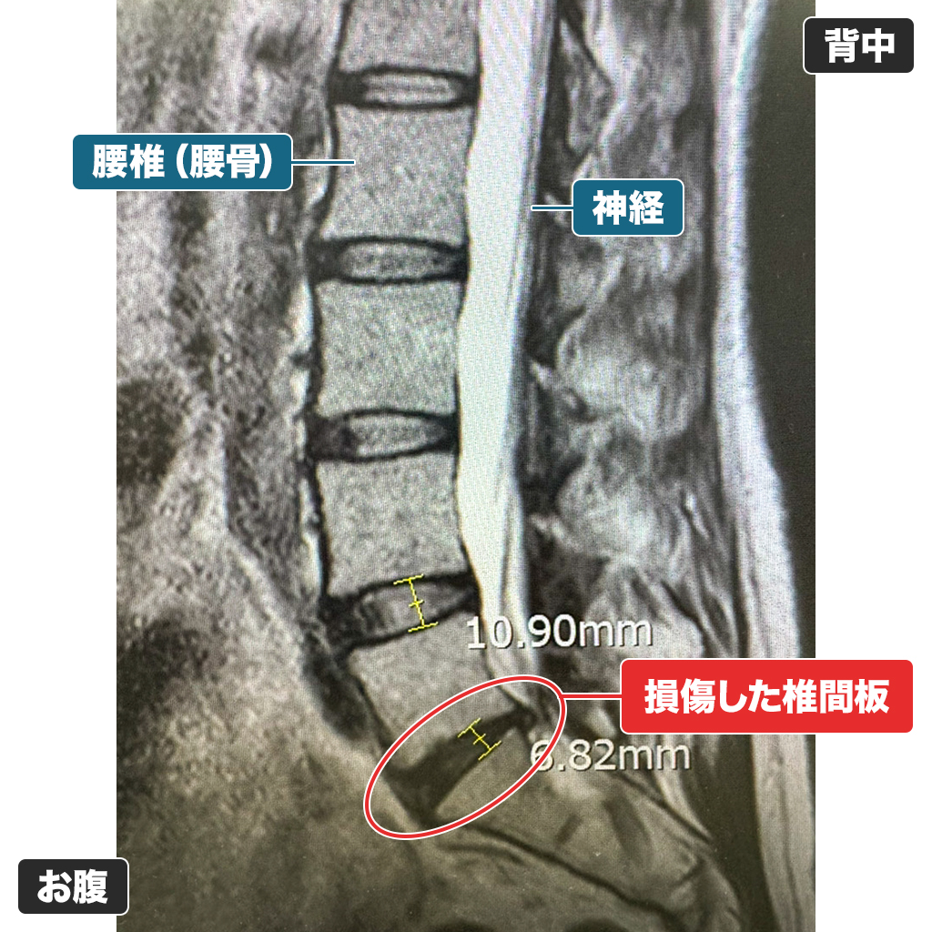 MRI