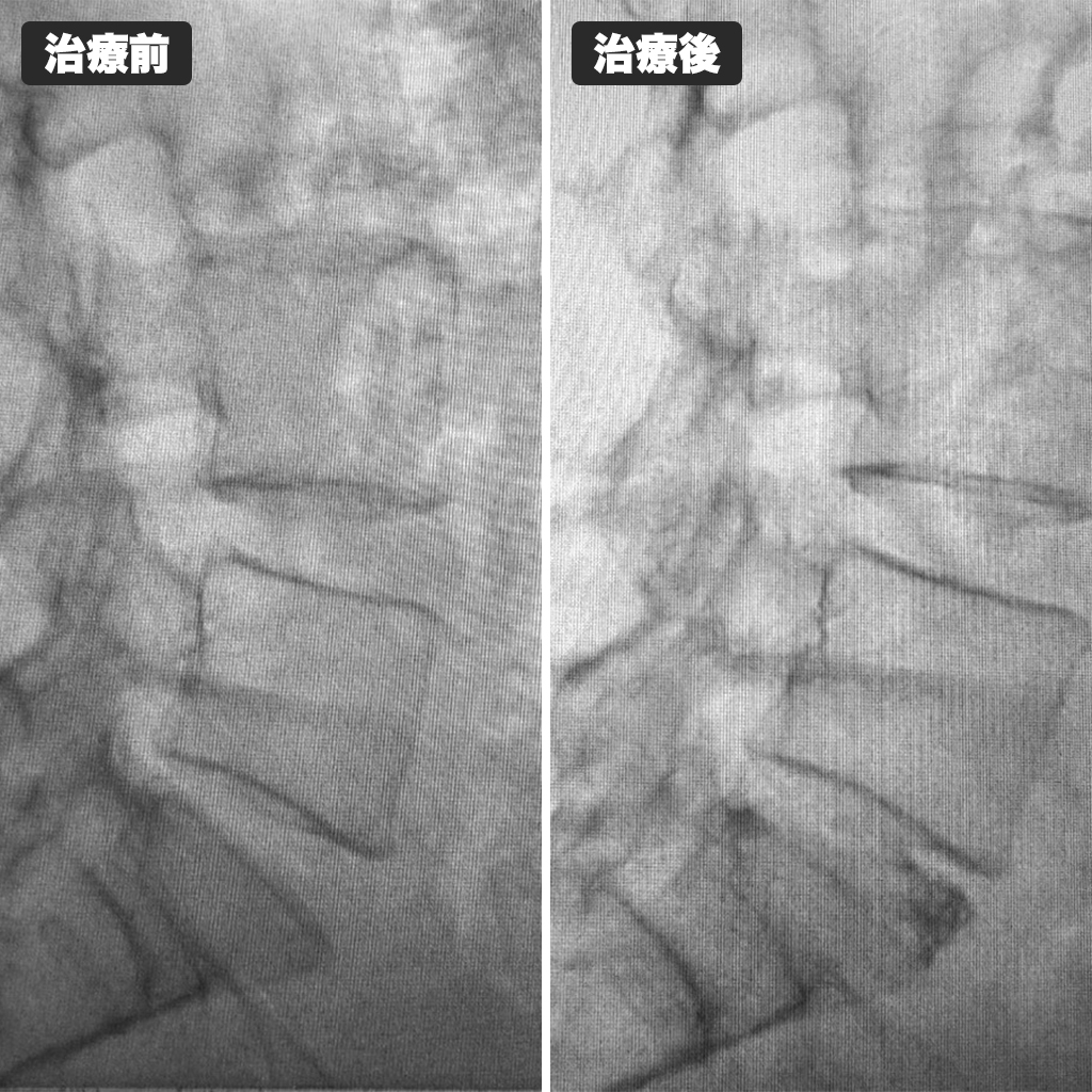 治療前後のレントゲン写真