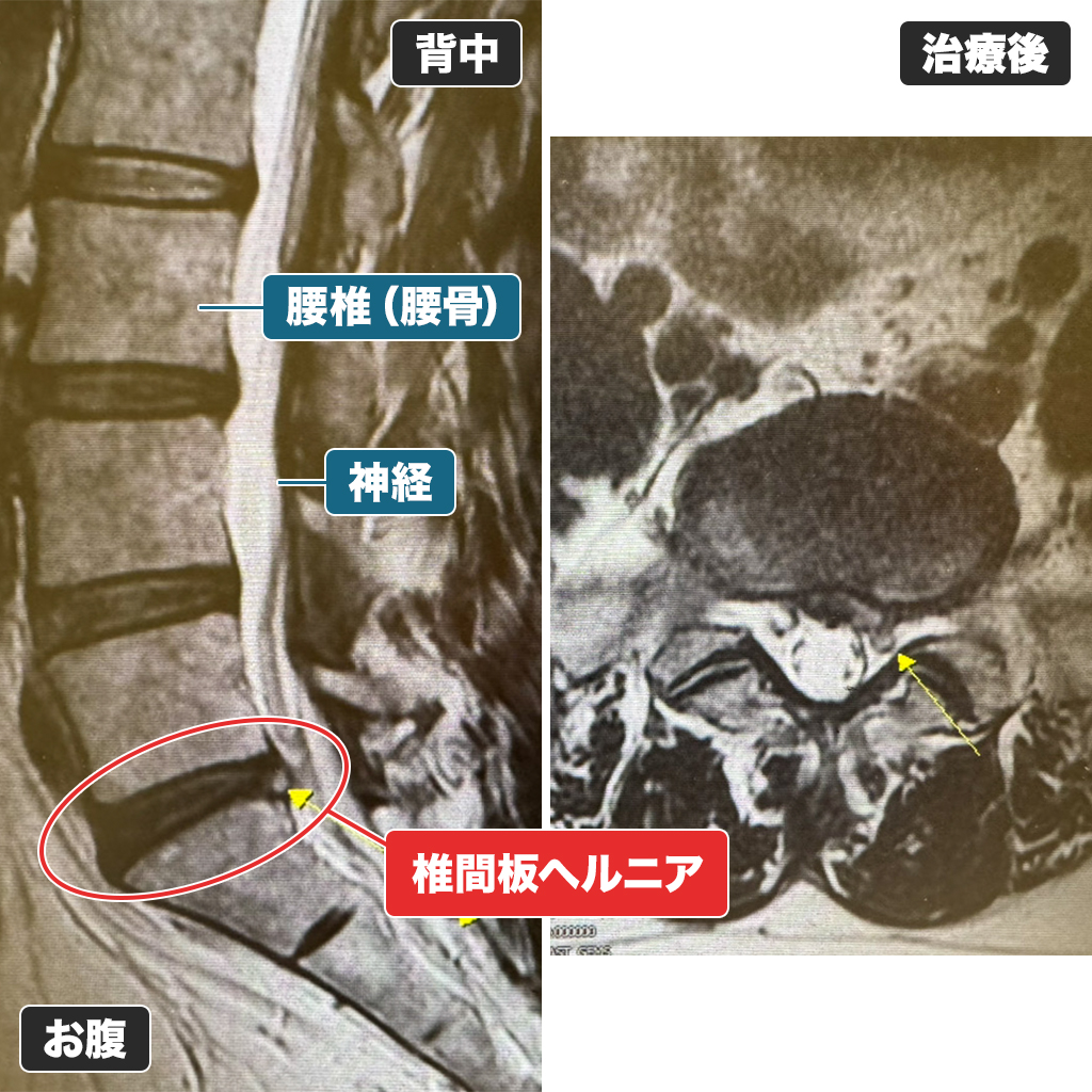 治療前のMRI写真