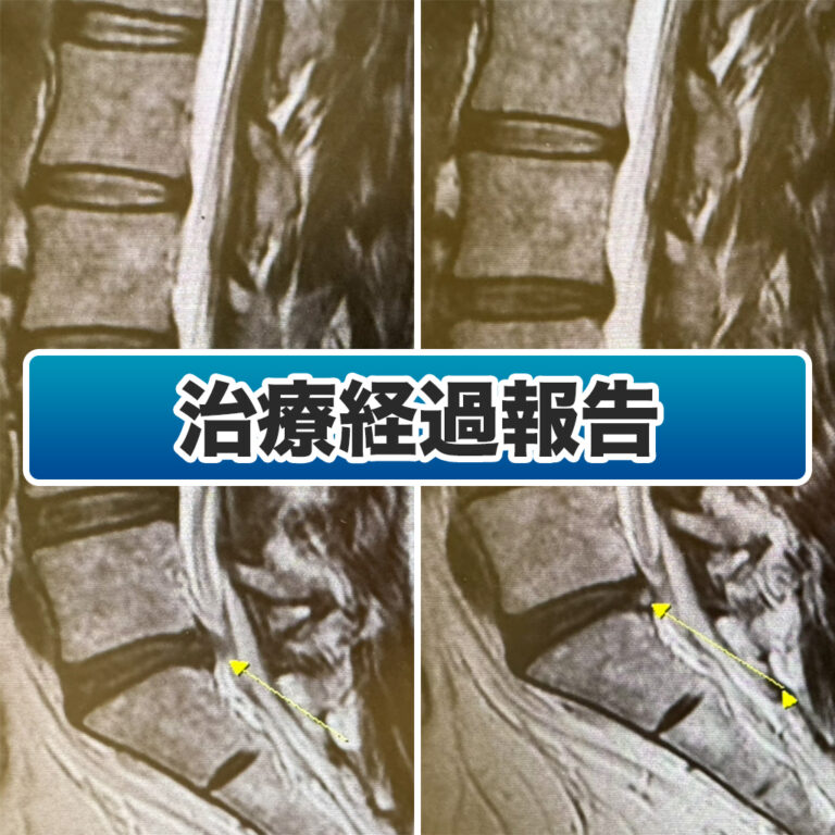 2度のPLDD（レーザー治療）後の患者様（20代男性）