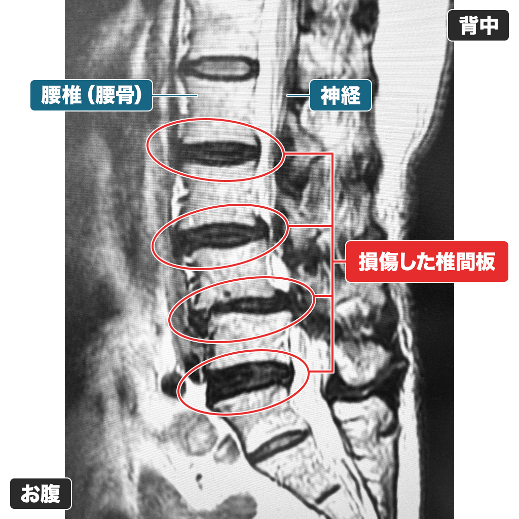 MRI