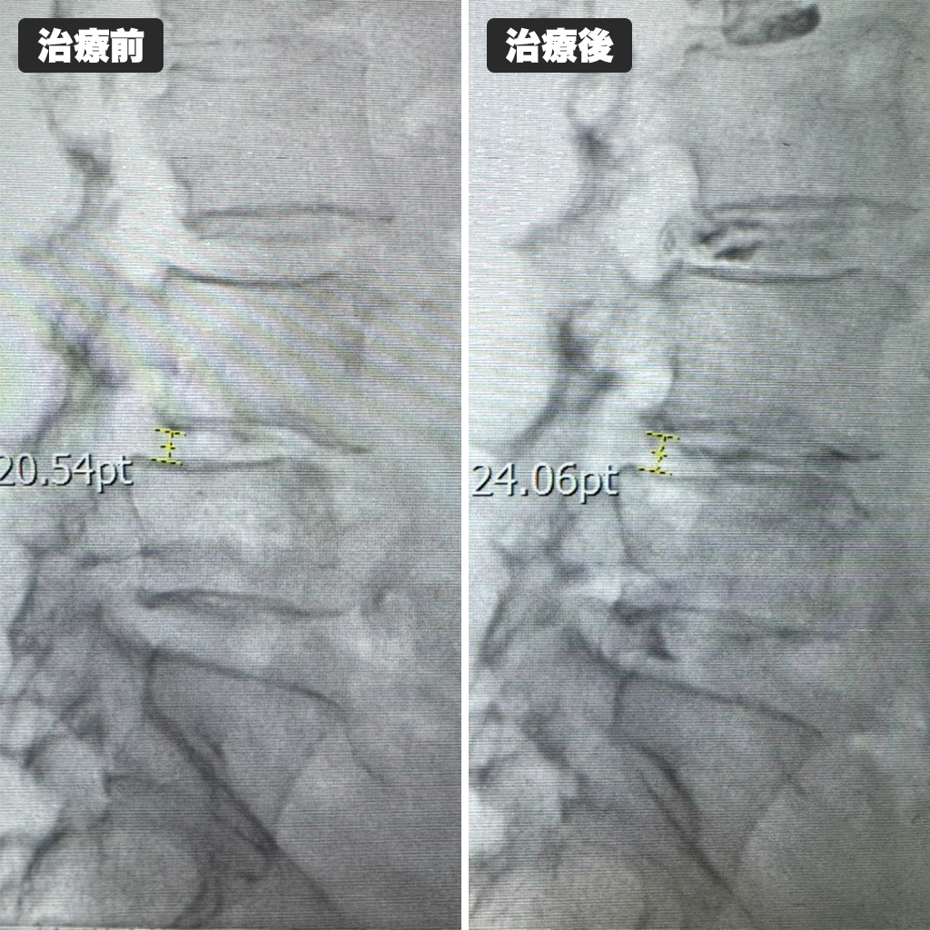 治療前後のレントゲン写真