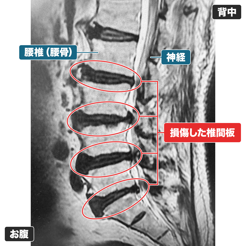 MRI