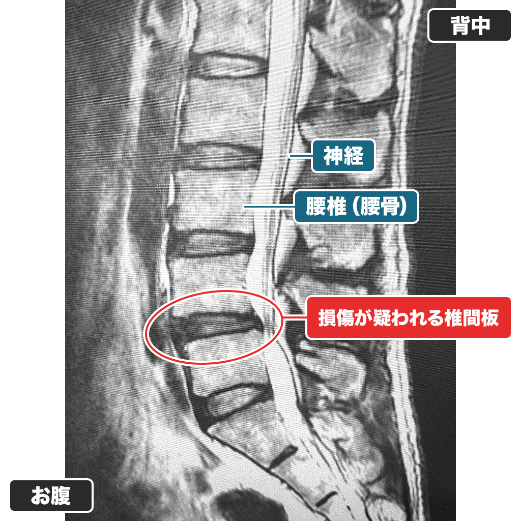 MRI