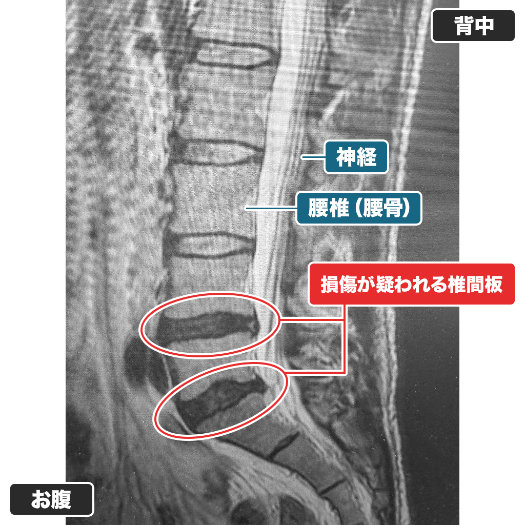 MRI