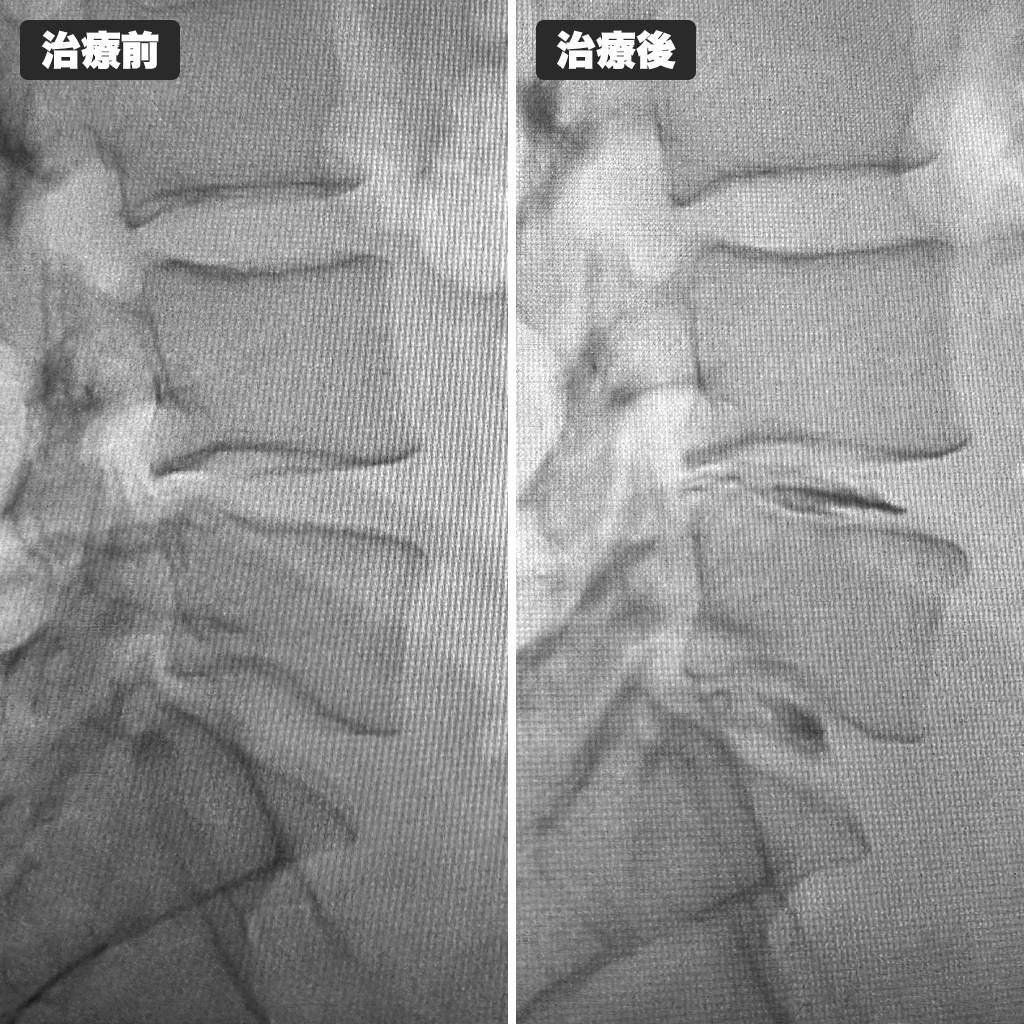 治療前後のレントゲン