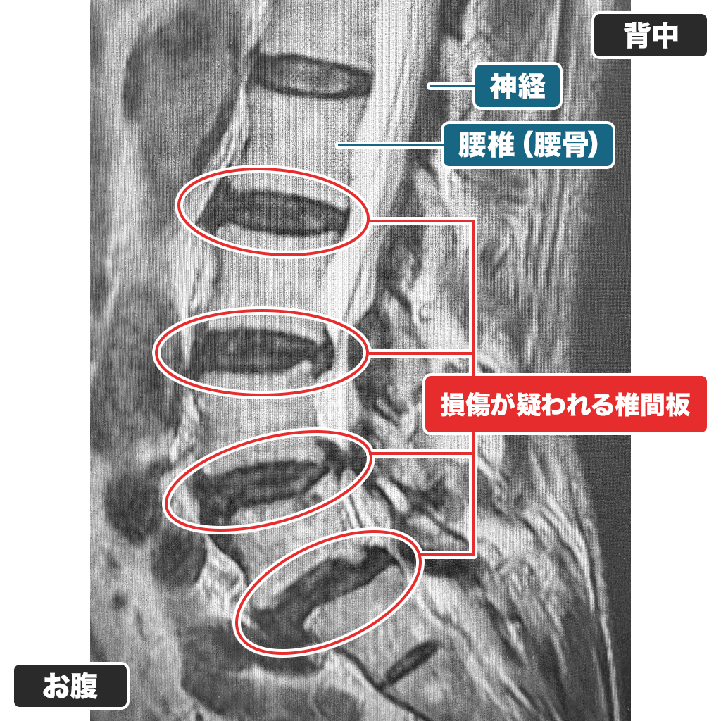 MRI