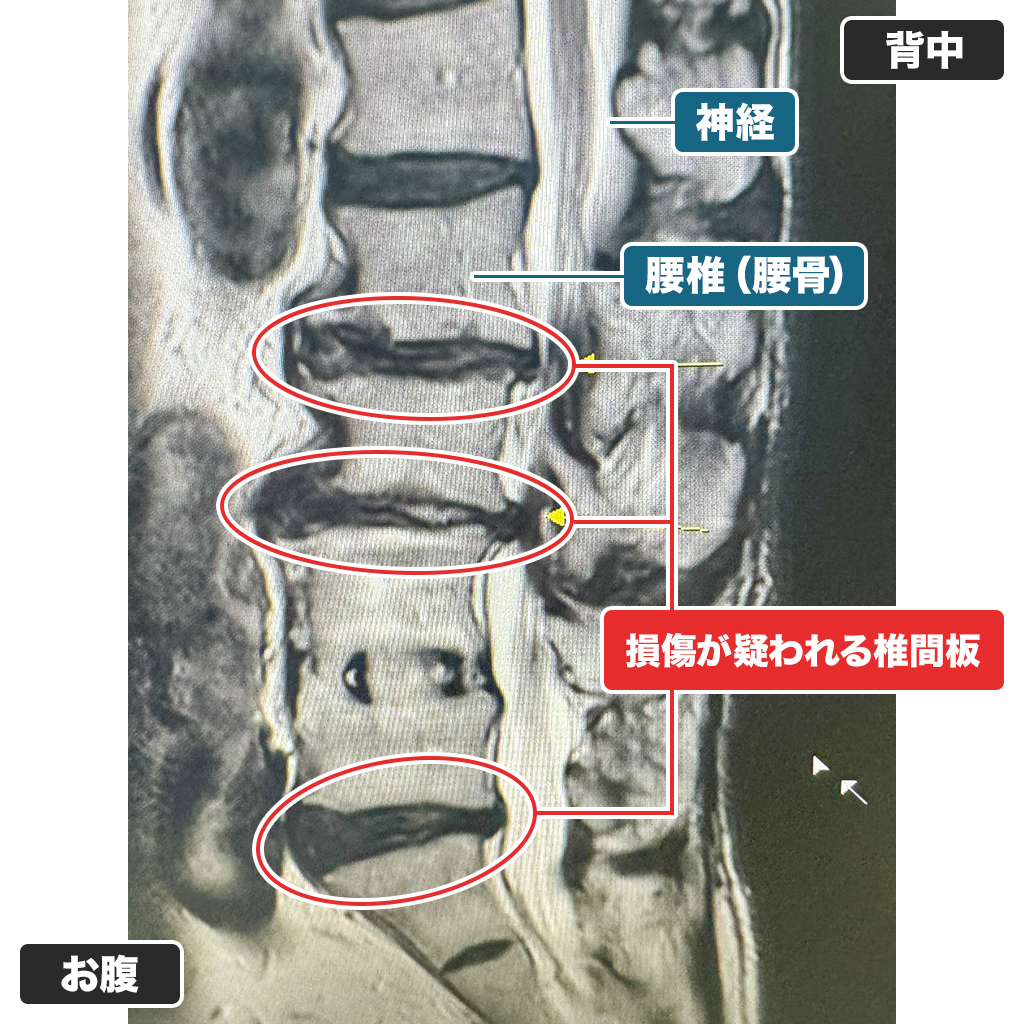 MRI