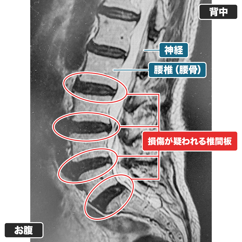MRI
