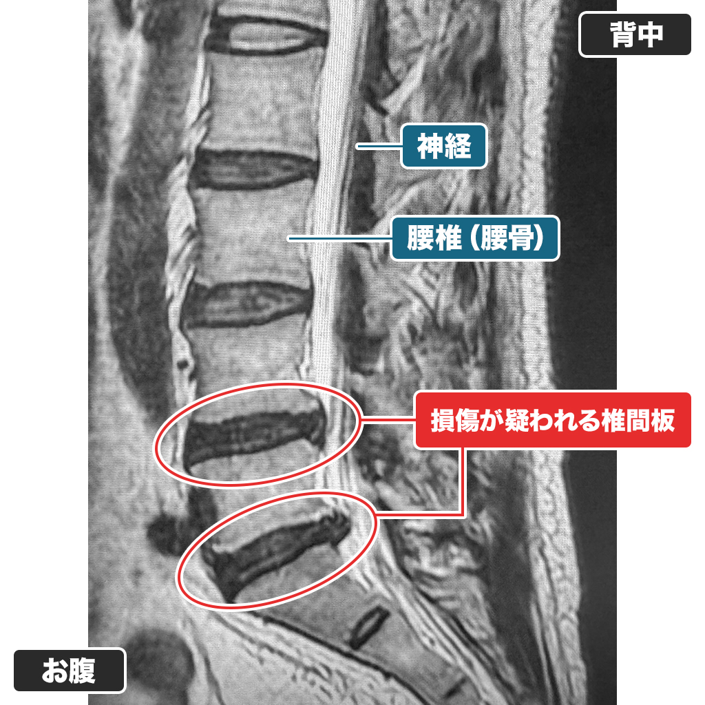 MRI