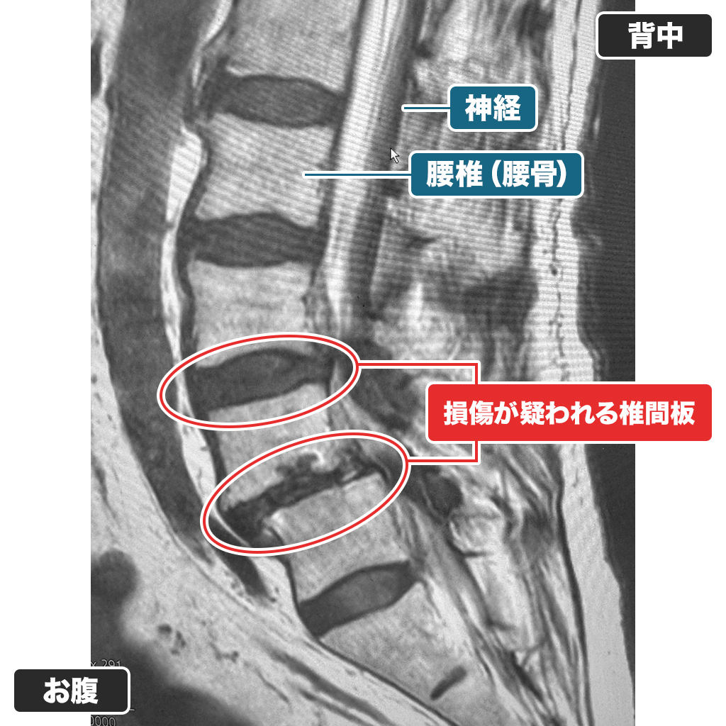 MRI