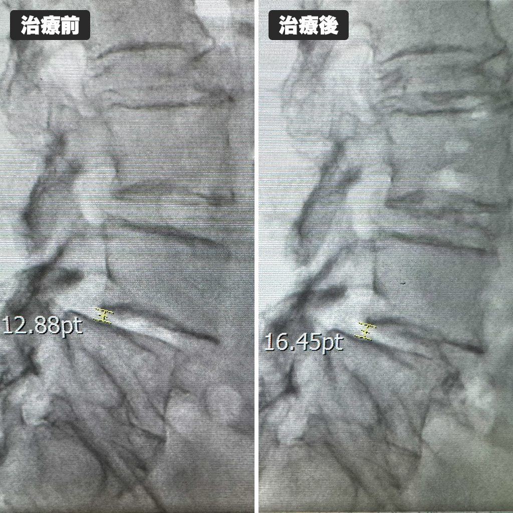治療前後のレントゲン