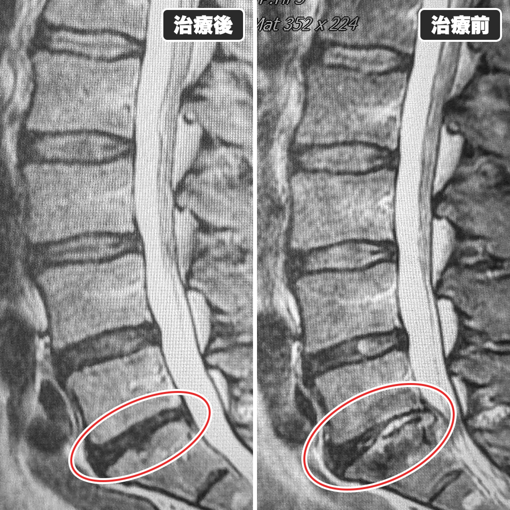 治療前後のMRI写真