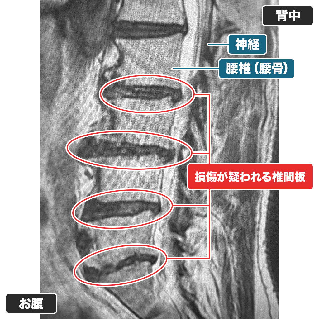 MRI