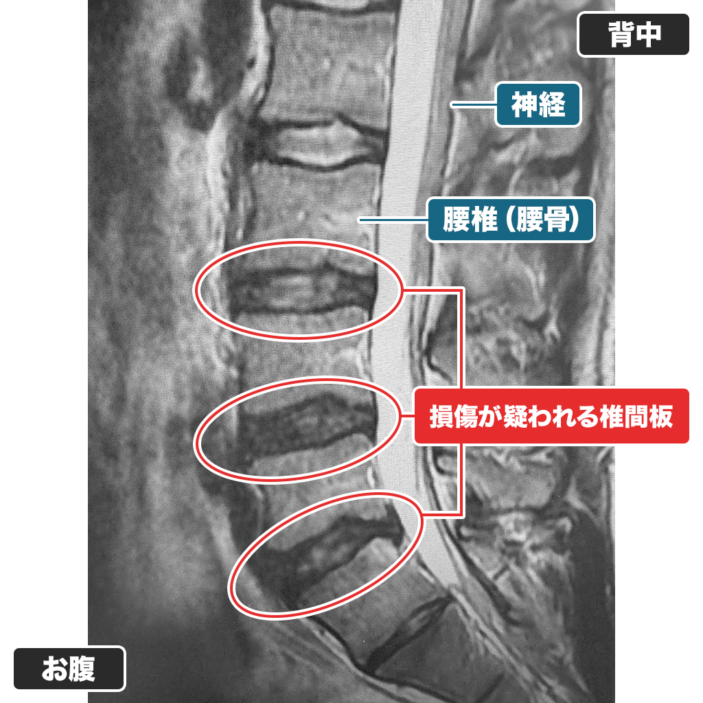MRI