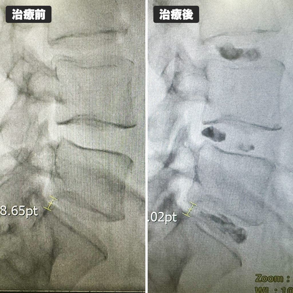 治療前後のレントゲン