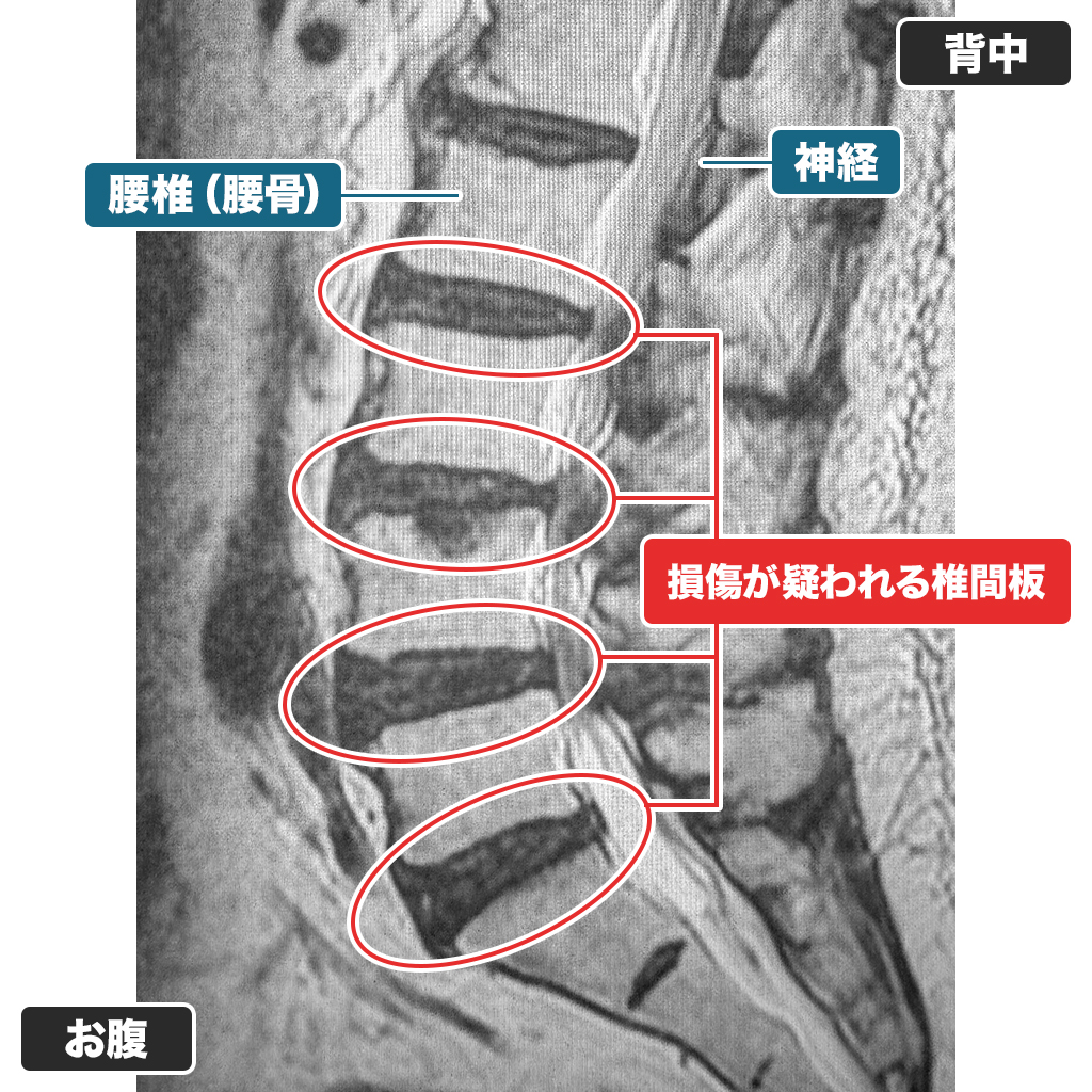 MRI