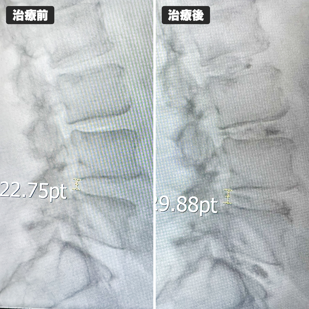 治療前後のレントゲン