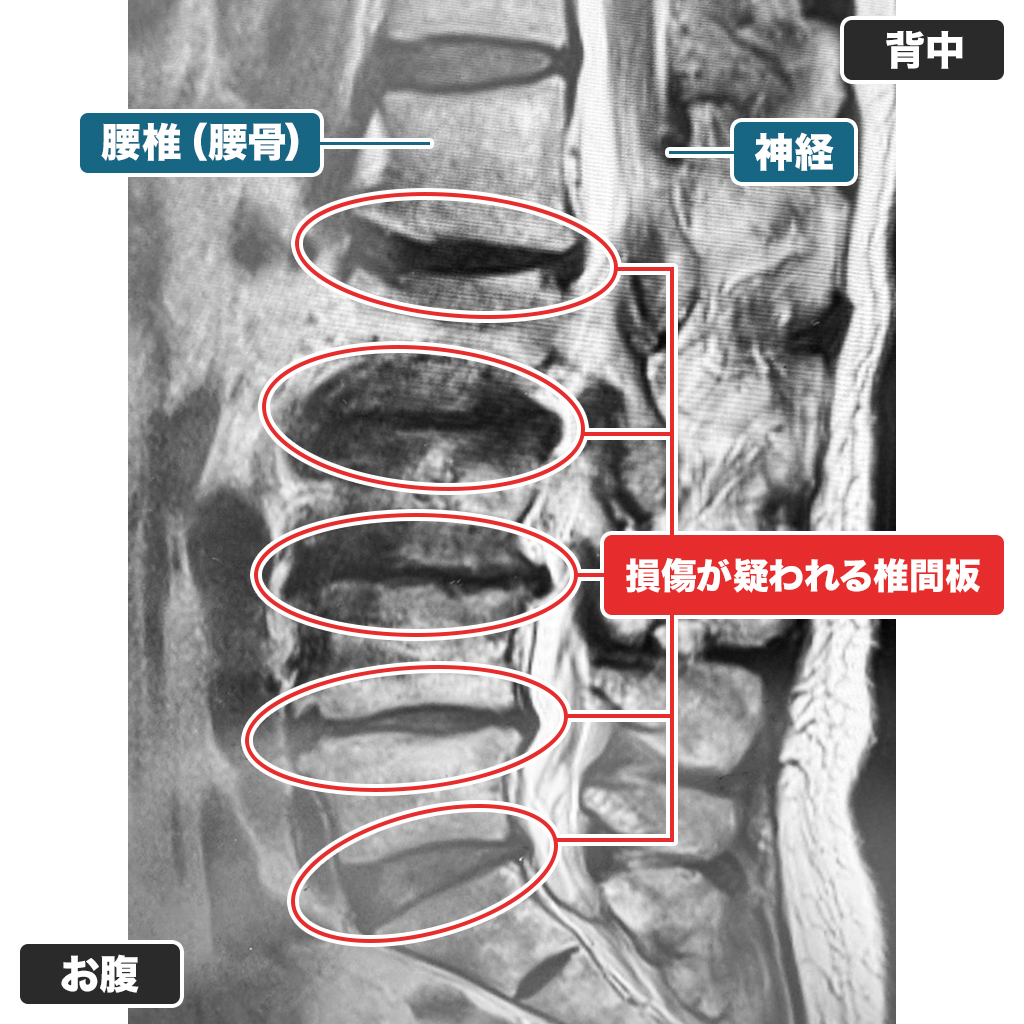 MRI