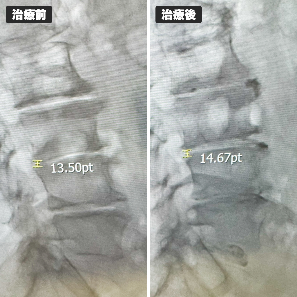 治療前後のレントゲン