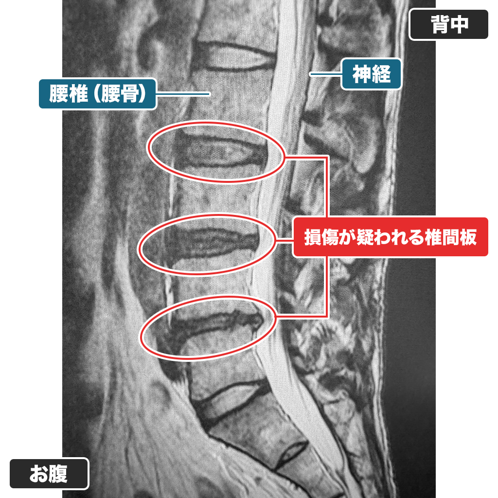 MRI