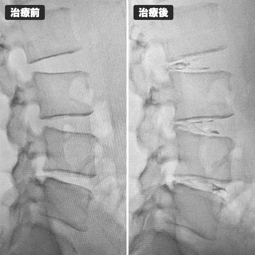 治療前後のレントゲン