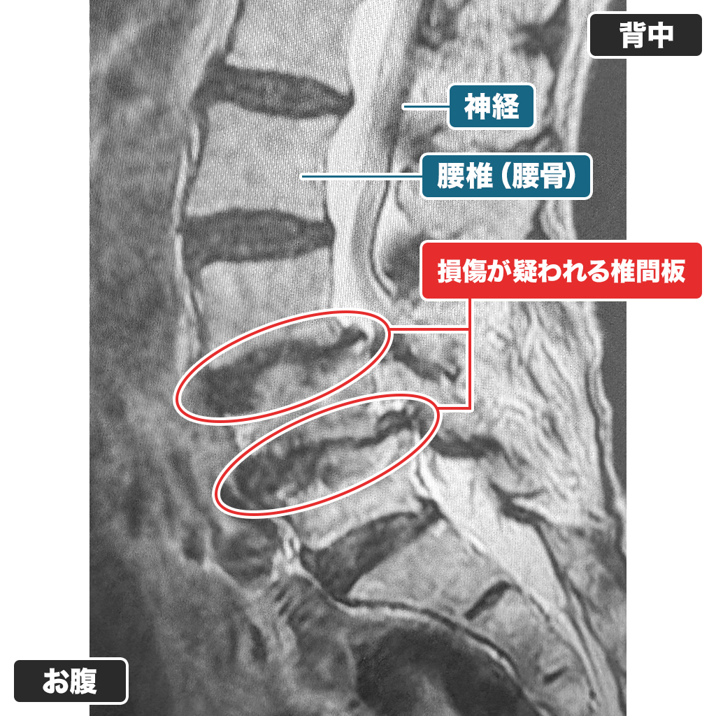 MRI