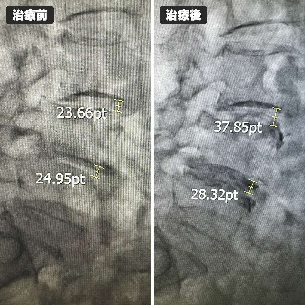 治療前後のレントゲン