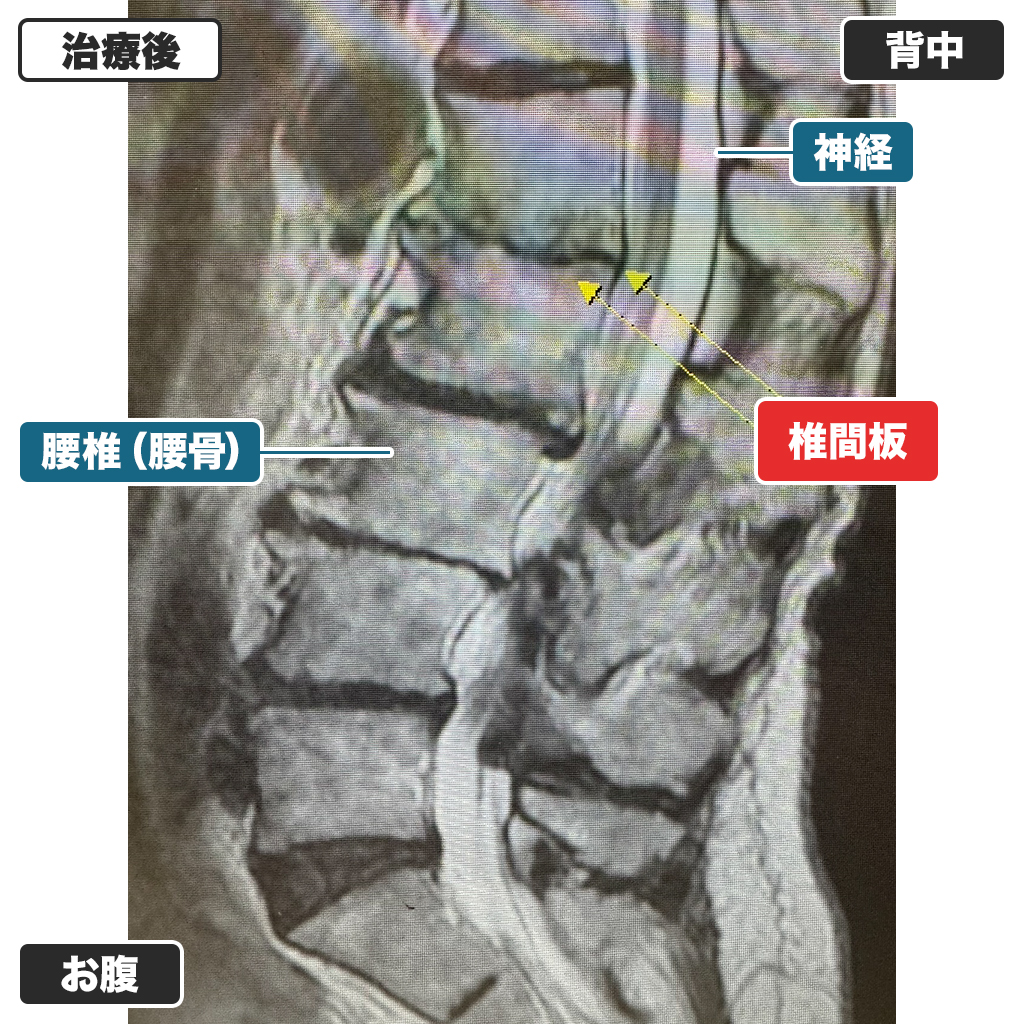 MRI写真(治療後)