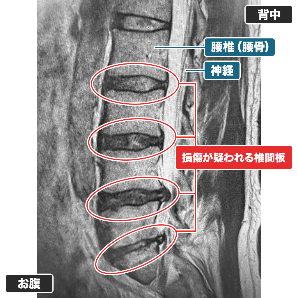 MRI