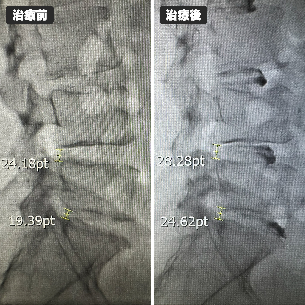 治療前後のレントゲン