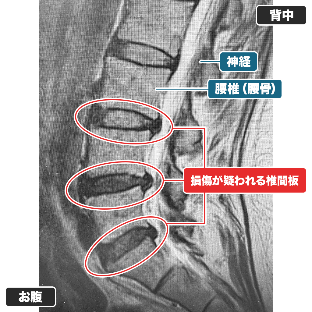 MRI