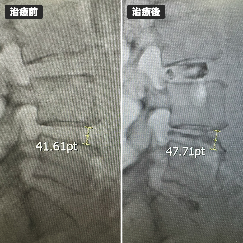 治療前後のレントゲン