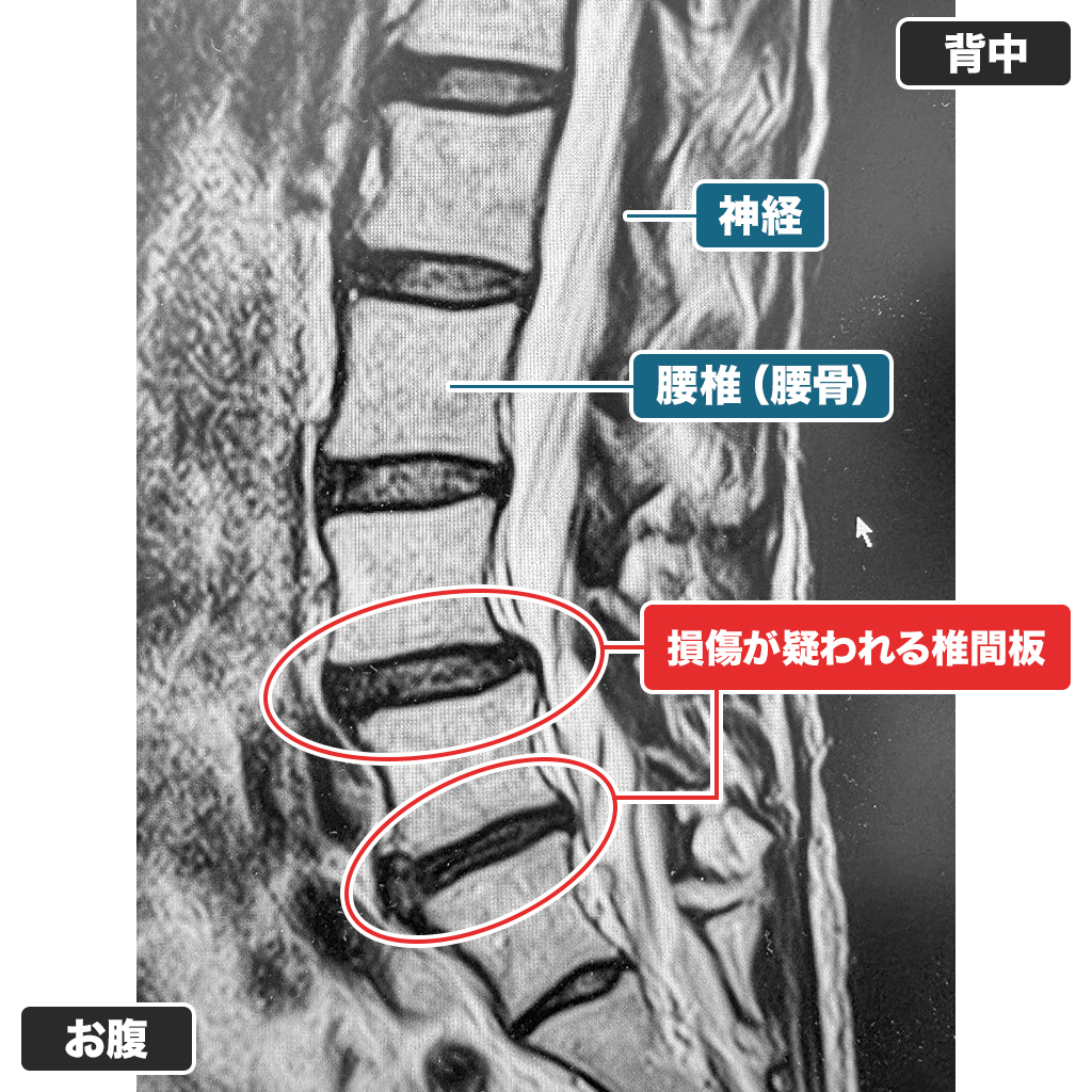 MRI