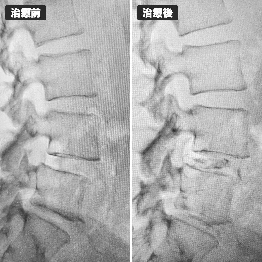 治療前後のレントゲン