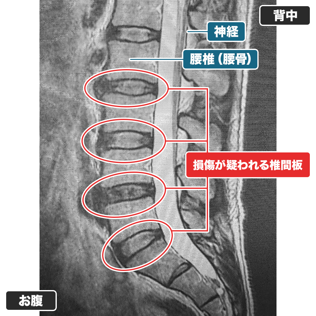 MRI